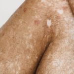 Patchy Spots - Crop black person with vitiligo skin condition